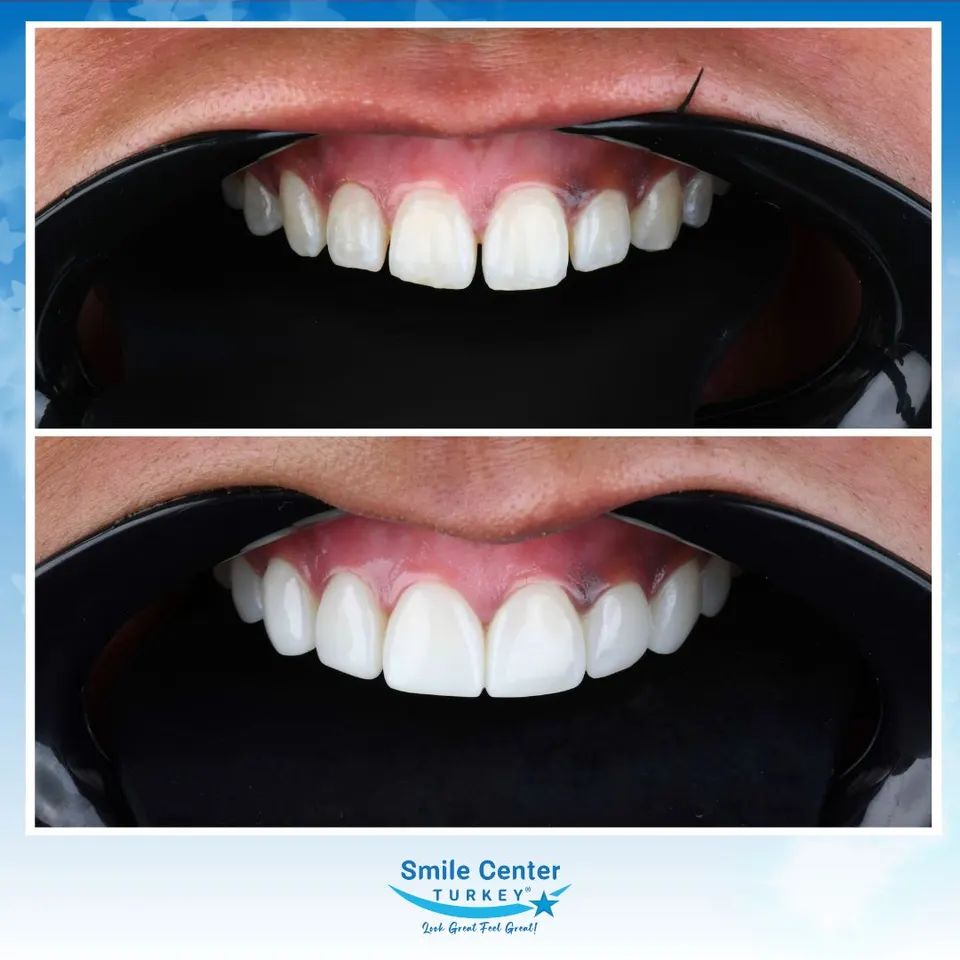 Komposit-Bonding zur Wiederherstellung abgebrochener oberer Frontzähne